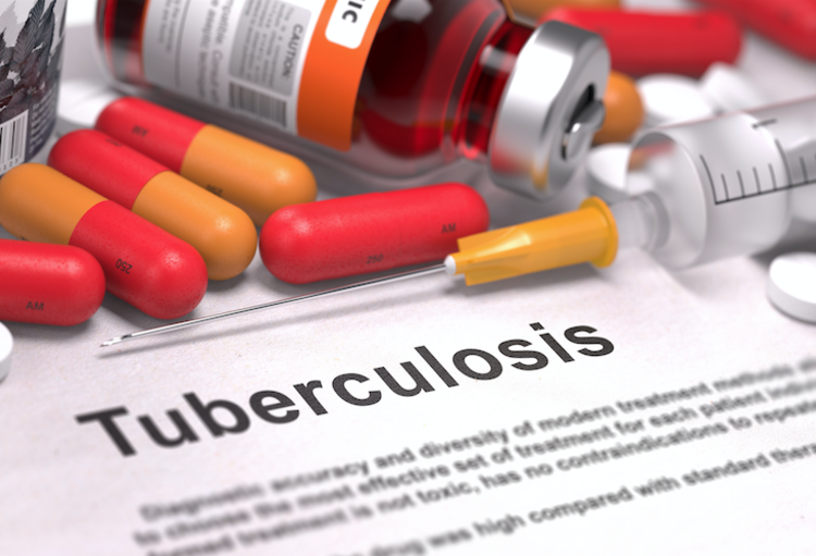 Tuberculose Causes Sympt Mes Traitement I Clinique Du Voyageur