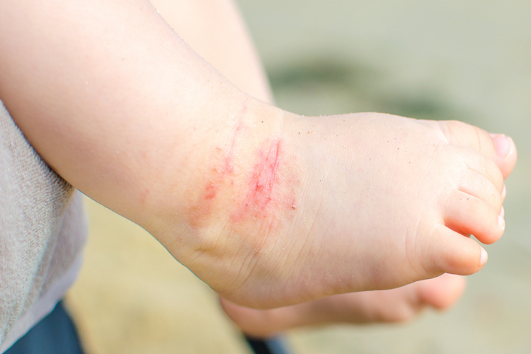 Atopische dermatitis als kind, later darmproblemen?