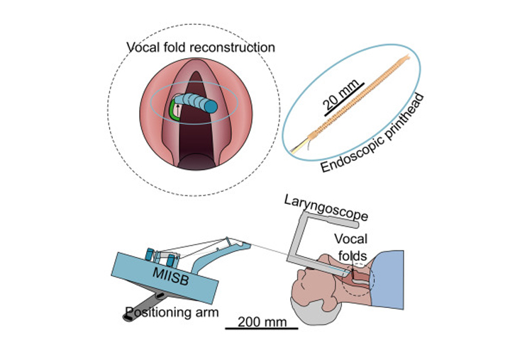 Une micro-imprimante 3D pour reconstruire les cordes vocales pendant la chirurgie