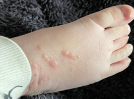 Casus: Eczema coxsackium: atypische klinische presentatie van hand-voet-mondziekte