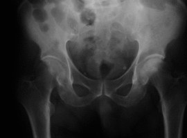 Symposium van de Belgian Bone Club: wie behandelen voor osteoporose?