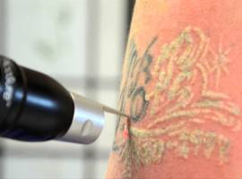 Le détatouage non chirurgical par la technique du laser constitue-t-il un acte médical ? (Ordre)