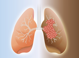 ASCO - Cancers du poumon: entre espoirs et déceptions