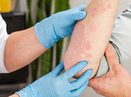 SPIN 2022: Des études qui cherchent à faire avancer les débats en cas de maladies inflammatoires de la peau