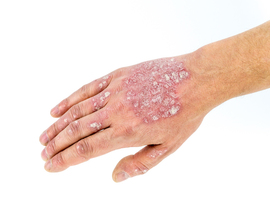 EADV 2022: Late-breaking news en dermatite atopique et en psoriasis
