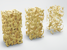 EULAR 2024: psoriatische artritis, osteoporose en spondyloartritis op het menu (deel 1)