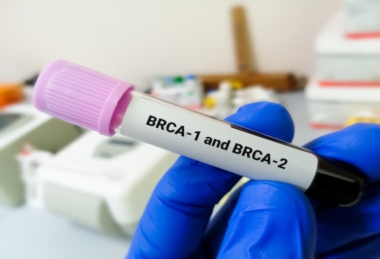 SABCS 2022: quelques études qui font réfléchir