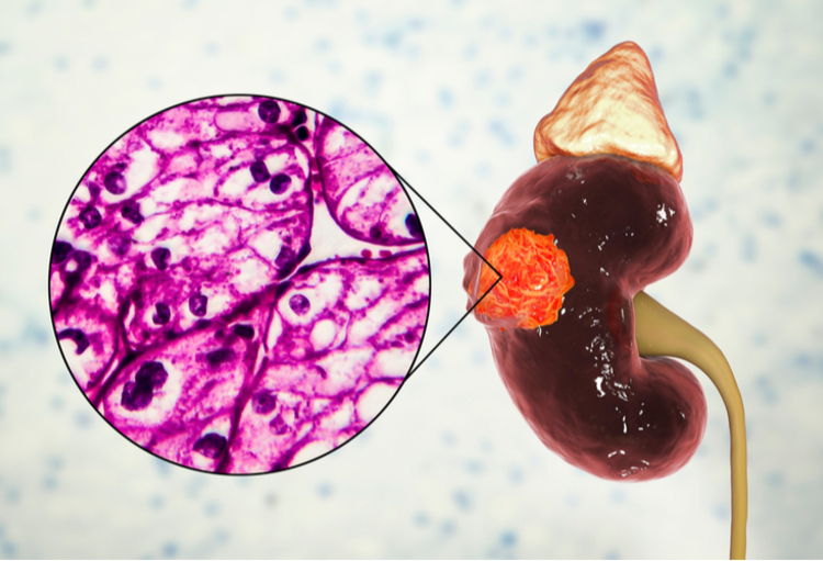 ASCO GU 2023: entre actualisation et progrès