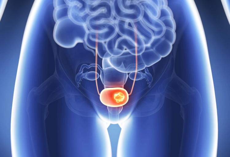 ASCO GU 2023: entre actualisation et progrès