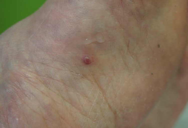 Une curieuse lésion du pied Skin