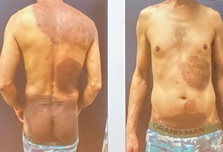 Difficult-to-treat tinea corporis - Skin