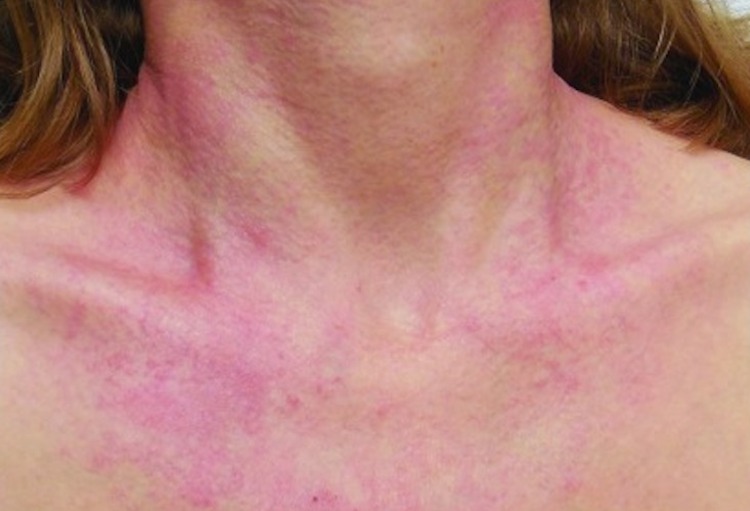 EADV 2022: Late-breaking news over atopisch eczeem en psoriasis