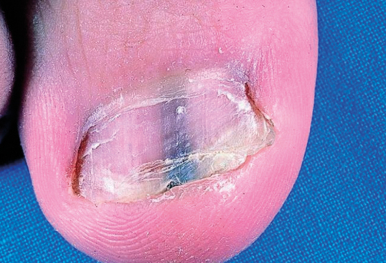 Quand les ongles sont ‘sales’… Skin