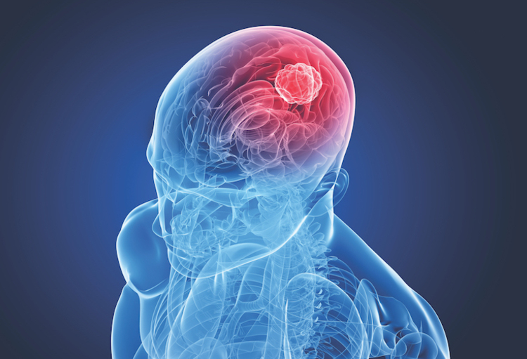 ASCO 2022: Hersentumoren: we zetten kleine stapjes, maar we komen vooruit…