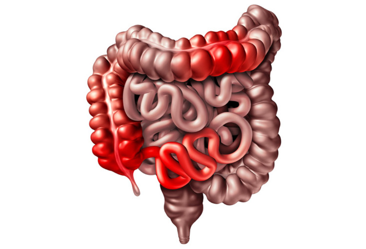 Spondyloartritis en activiteit van de ziekte van Crohn OrthoRhumato Spondyloartritis en activiteit van de ziekte van Crohn OrthoRhumato