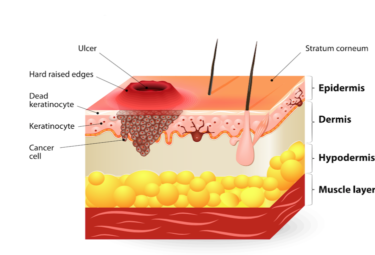 EGFR En Spinocellulair Carcinoom Skin