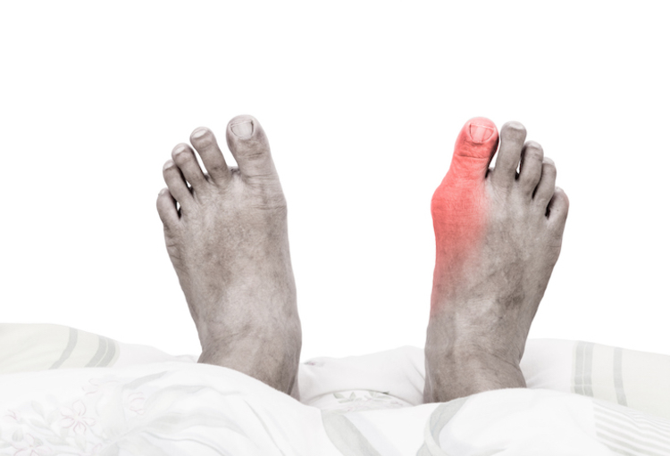 Goutte: une maladie «agréable à prendre en charge», à condition de bien ...