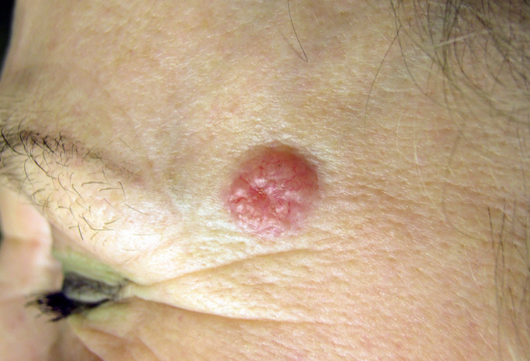 Wanneer de EADV  een aantal ziekten voor  het voetlicht brengt…