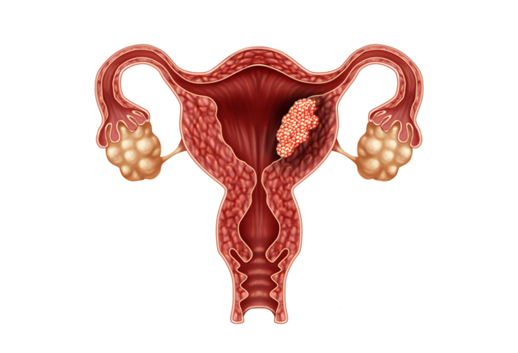 ASCO Annual Meeting 2019: L’oncologie gynécologique est en pleine évolution