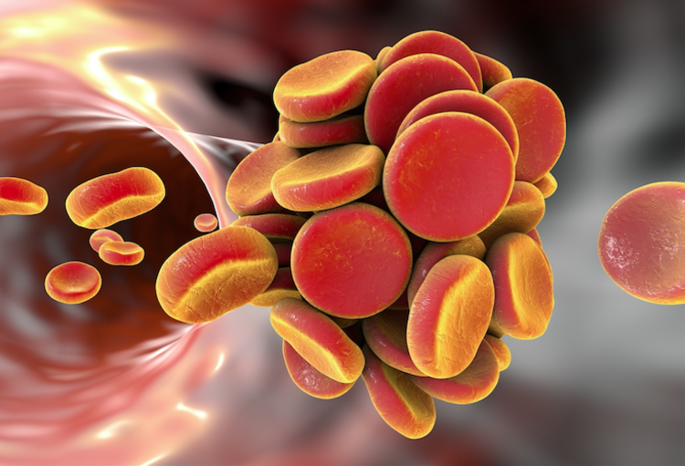 Les priorités ‘practice changing’ de l’ASH (59th annual meeting of the American Society of Hematology, Atlanta, 9-12 décembre 2017)
