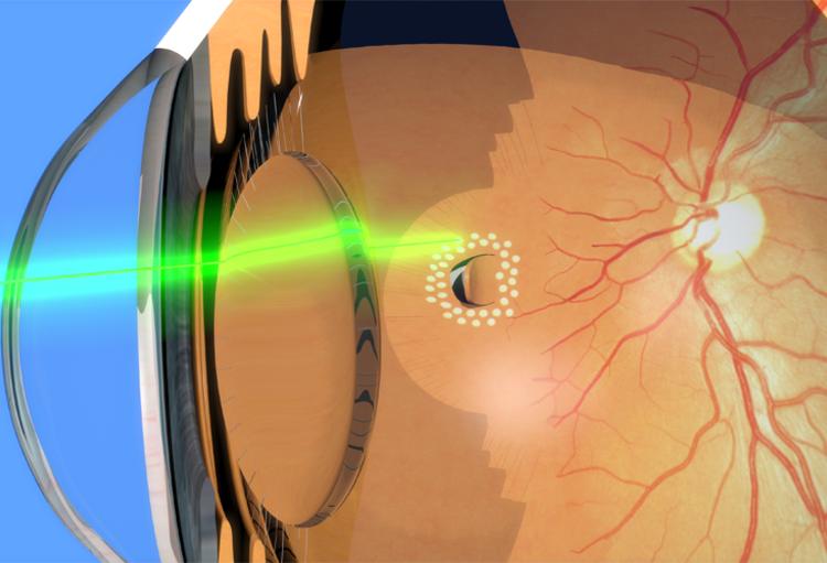 Congres van de Société Française d'Ophtalmologie 2019 (SFO)