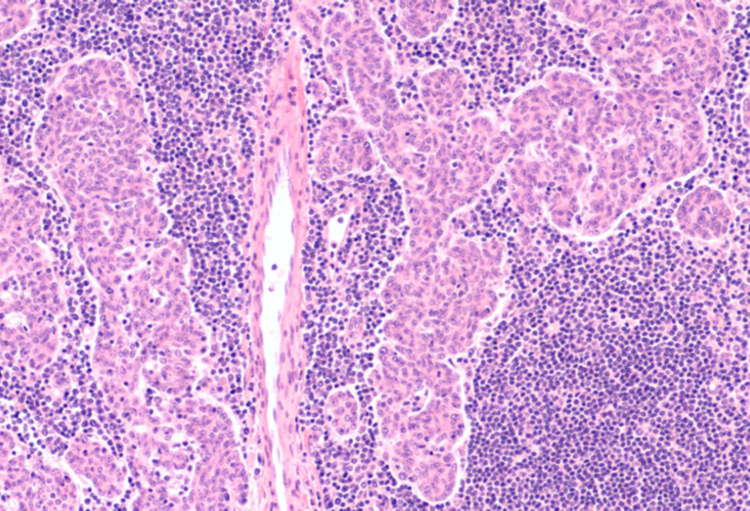 European Lung Cancer Congress