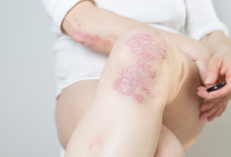 SPIN 2022: Des études qui cherchent à faire avancer les débats en cas de maladies inflammatoires de la peau