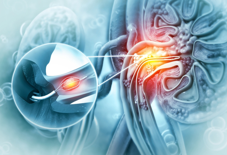 2nd symposium on Kidney Stones and Mineral Metabolism