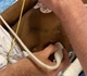 Une jeune patiente opérée du cœur via le foie aux Cliniques Saint-Luc